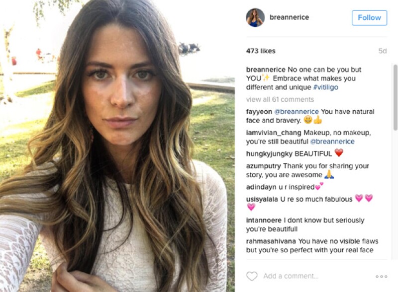 Breanne Rice tiene 31 años y ha vivido con vitiligo desde los 19.