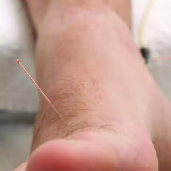 Acupuntura en pies