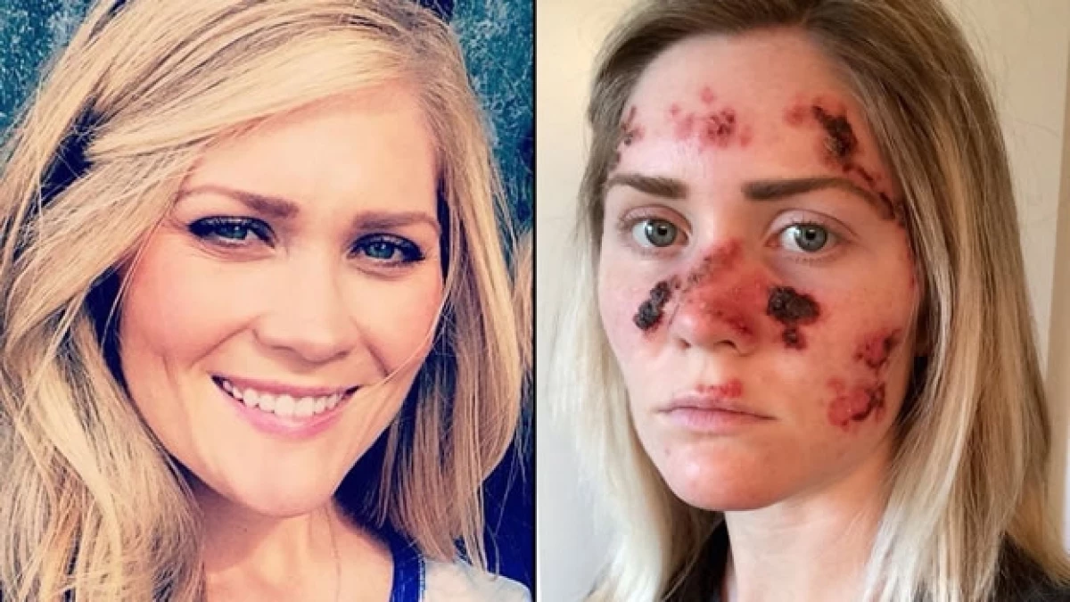 Tawny Willoughby y una foto antes y después de haber usado por años una cama de bronceado