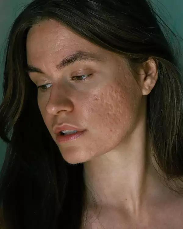 acne-positivity.jpg