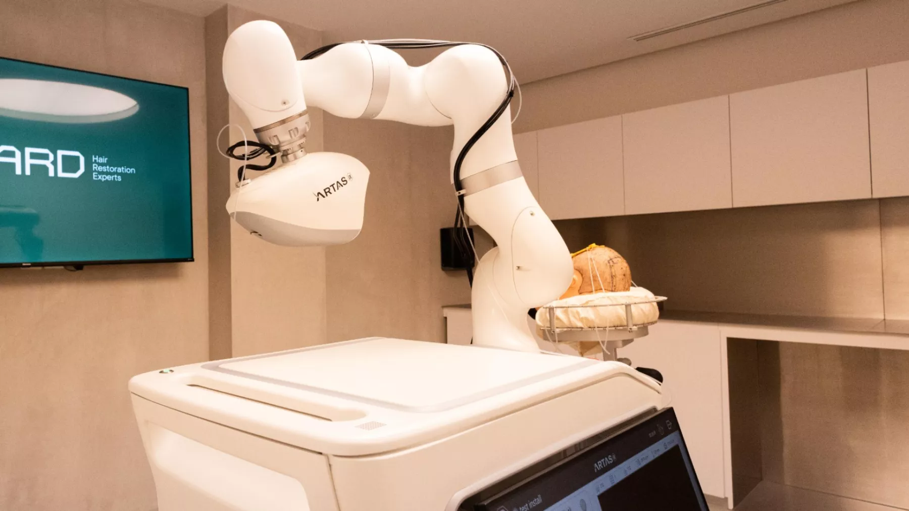 ARTAS iX, el robot que ayuda en injertos capilares