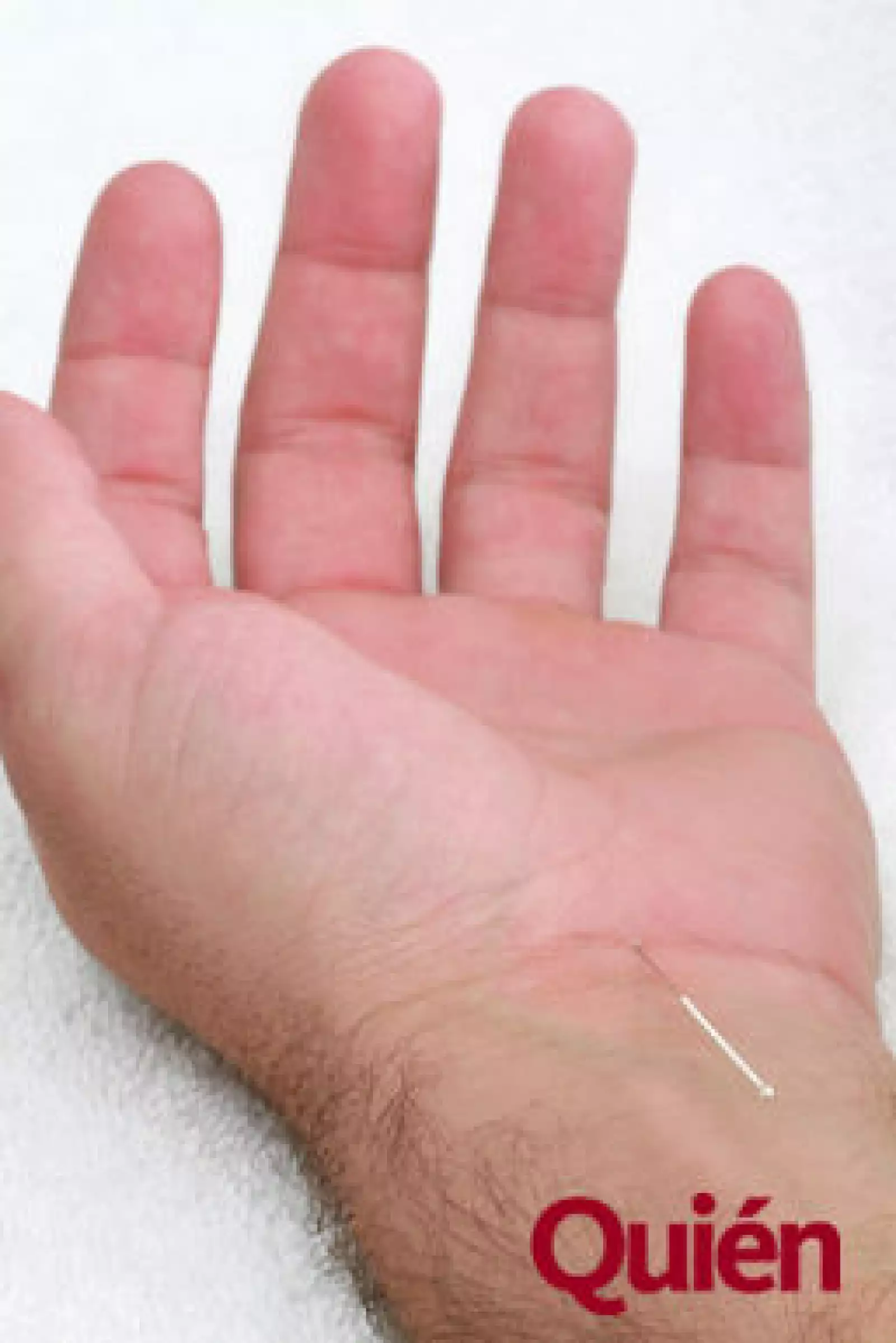 Acupuntura en mano