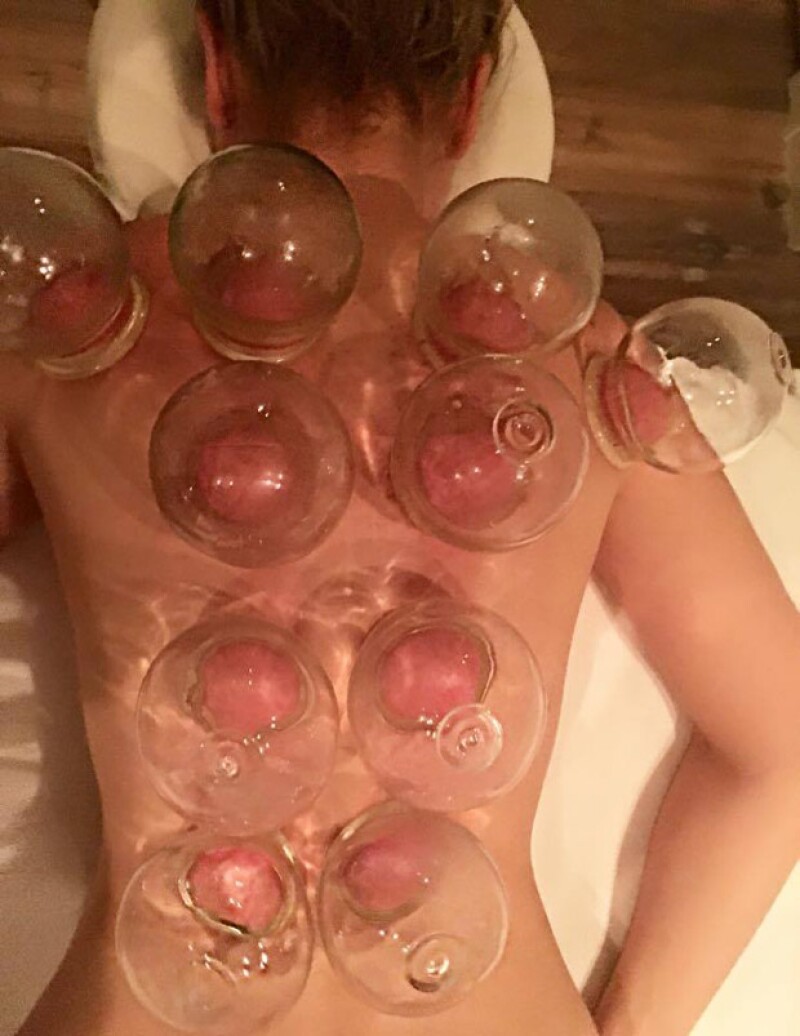 ¿Alguien dijo albóndigas?!...😳😂😂🔥🙈💖 #cupping #cuppingtherapy #holistichealth #medicinaalternativa #loveit