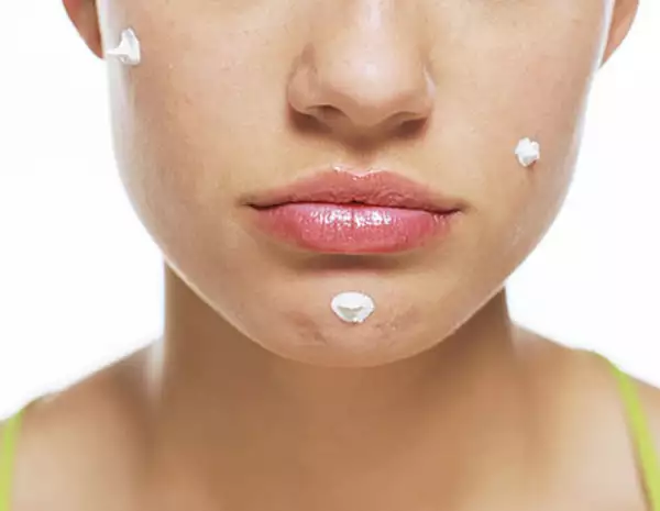 La pasta de dientes puede llegar a quemar tu piel si la aplicas sobre esta.