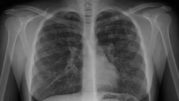 pulmones radiografia fibrosis