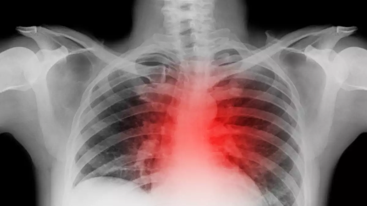 infarto ataque cardiaco