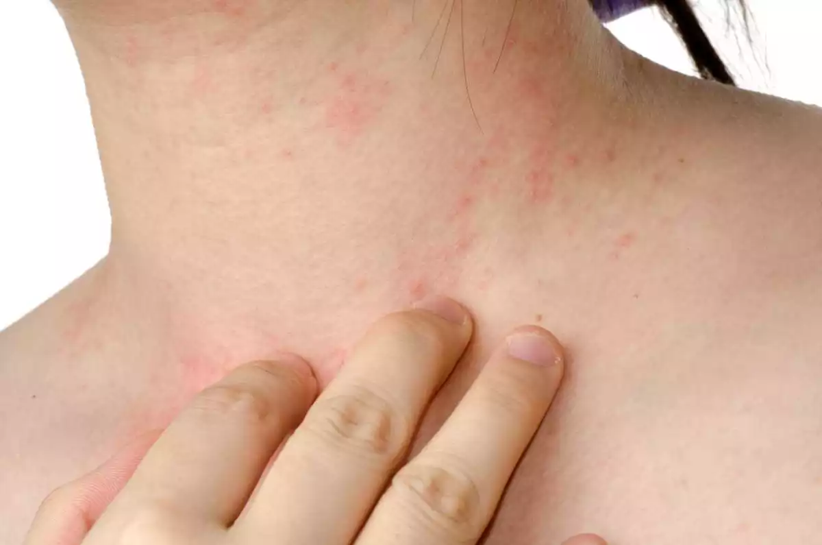 La dermatitis atópica: una enfermedad tan popular como desconocida