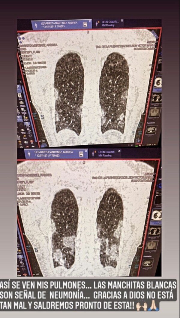 Pulmones de Andrea Legarreta