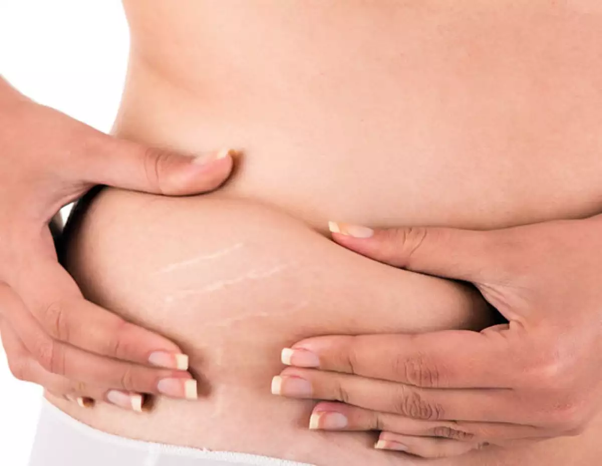 Las estrías pueden aparecer en color rojo, morado, rosa o blanco.