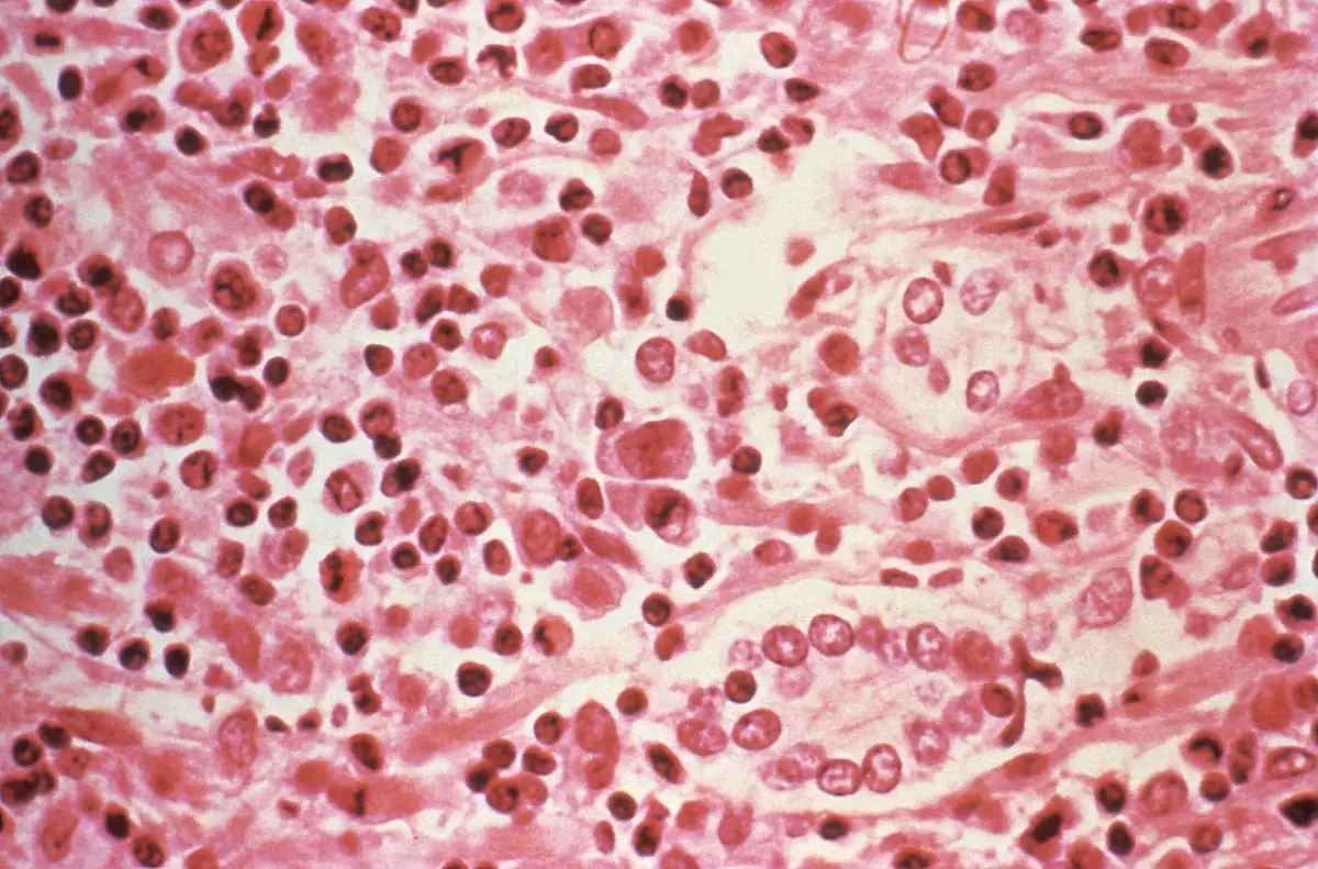 Esta foto de folleto de 1994 de los Centros para el Control y la Prevención de Enfermedades (CDC) de los Estados Unidos obtenida el 6 de mayo de 2026, muestra una fotografía tomada a través de un microscopio de una muestra de tejido hepático que se extrajo de un paciente con síndrome pulmonar por hantavirus (HPS).