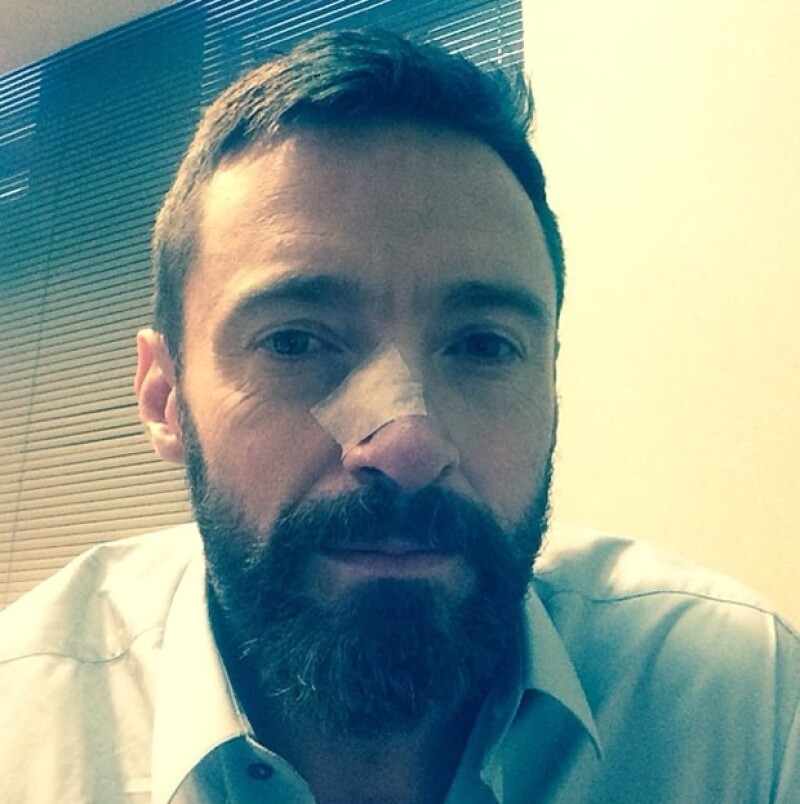 El actor se sometió por segunda vez a un procedimiento para retirar un carcinoma basal, asegura que ya todo está retirado.
