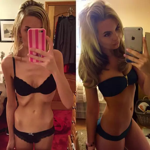 Hayley comparte en su cuenta de Instagram fotos del antes y después de su anorexia.