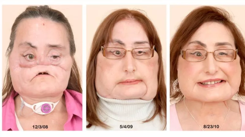 trasplante de rostro