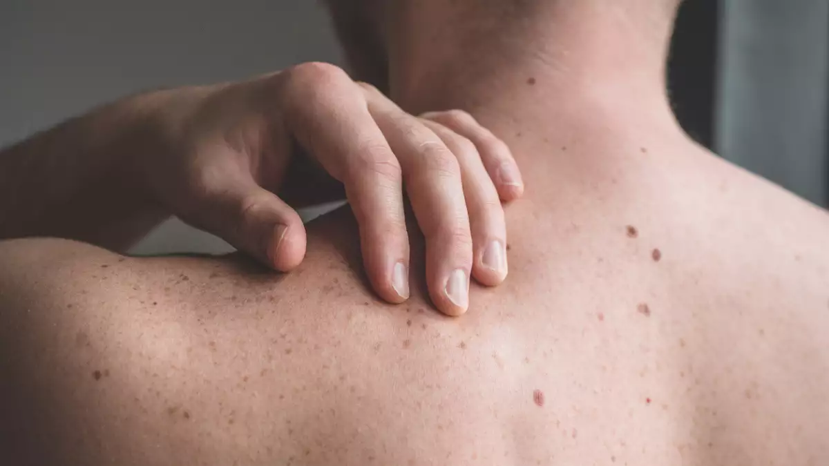 ABCDE-Melanoma-LaRoche.png