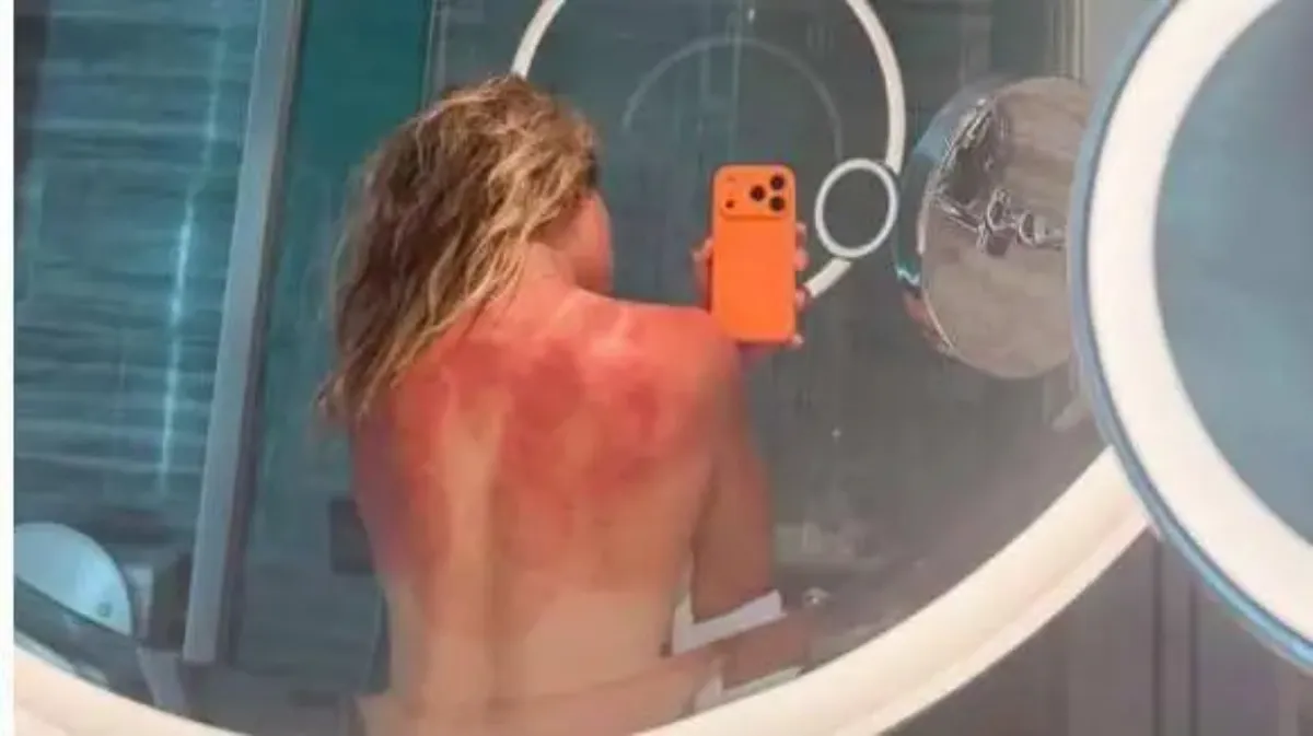 La tenista Renata Zarazúa muestra las quemaduras en su espalda causadas por el sol en Australia