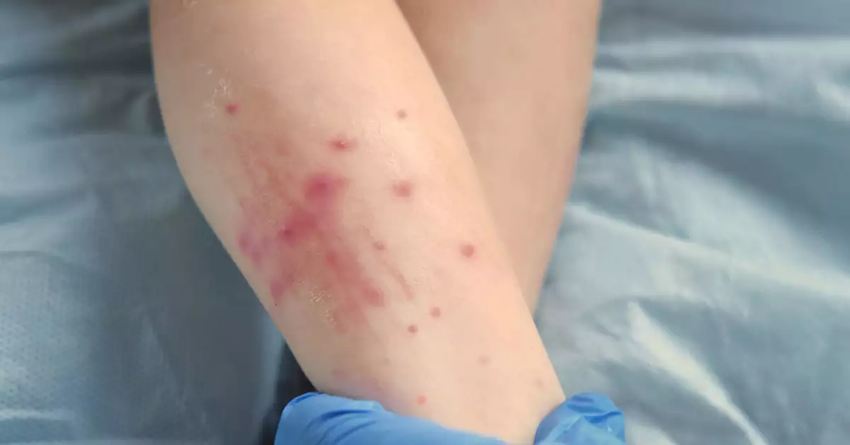 ¿Qué es el sarampión y cuáles son sus síntomas? La UNAM alerta por contagios