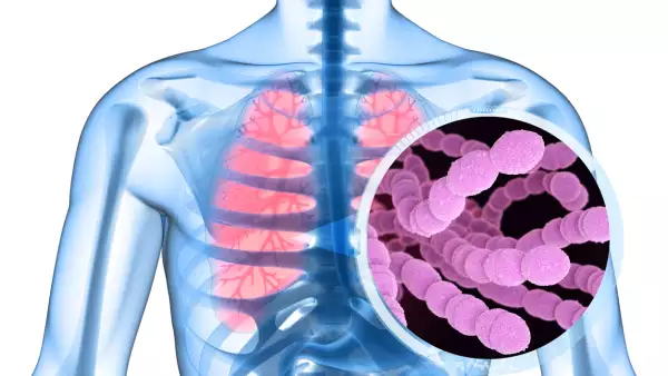 ¿Qué es un choque séptico?