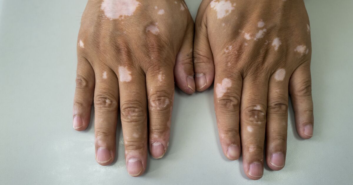White spots on the skin? These are the symptoms of vitiligo White spots on the skin? These are the symptoms of vitiligo