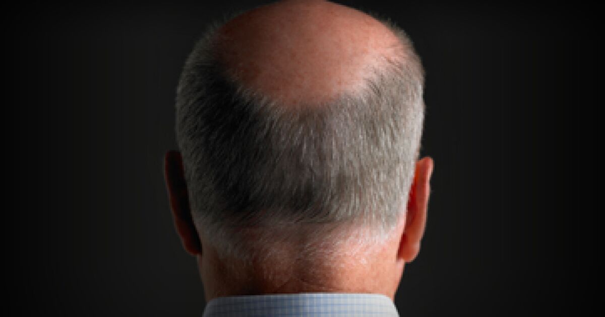 It is sexual harassment to call a man bald. It is sexual harassment to call a man bald.
