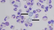 Ameba comecerebros en color azul que infectan a las células del cerebro en color morado.jpg