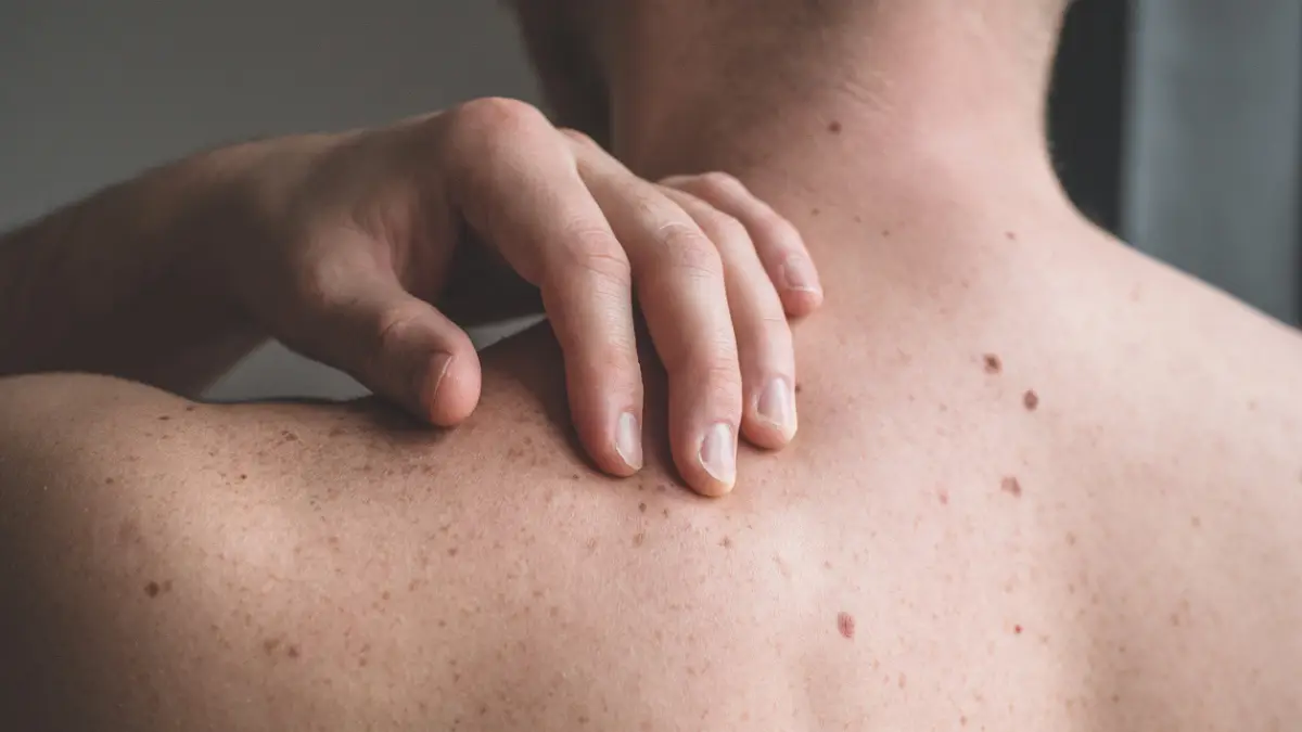 ABCDE-Melanoma-LaRoche.png