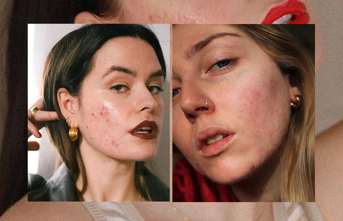 piel-imperfecciones-2.jpg