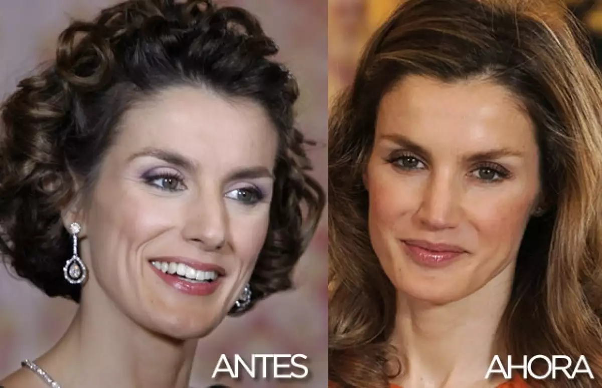 Aquí el antes y el después de su operación en la nariz.
