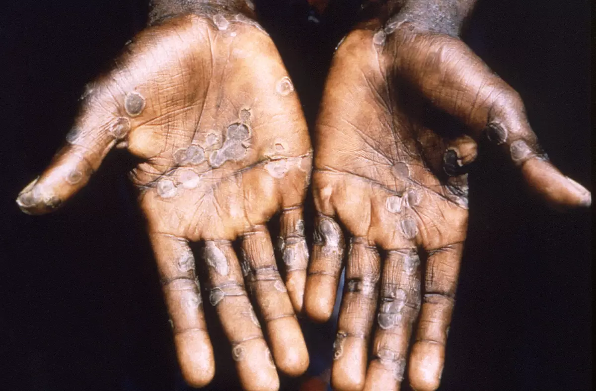 Las palmas de un paciente con viruela del mono en Lodja, República democrática del Congo en 1997. 