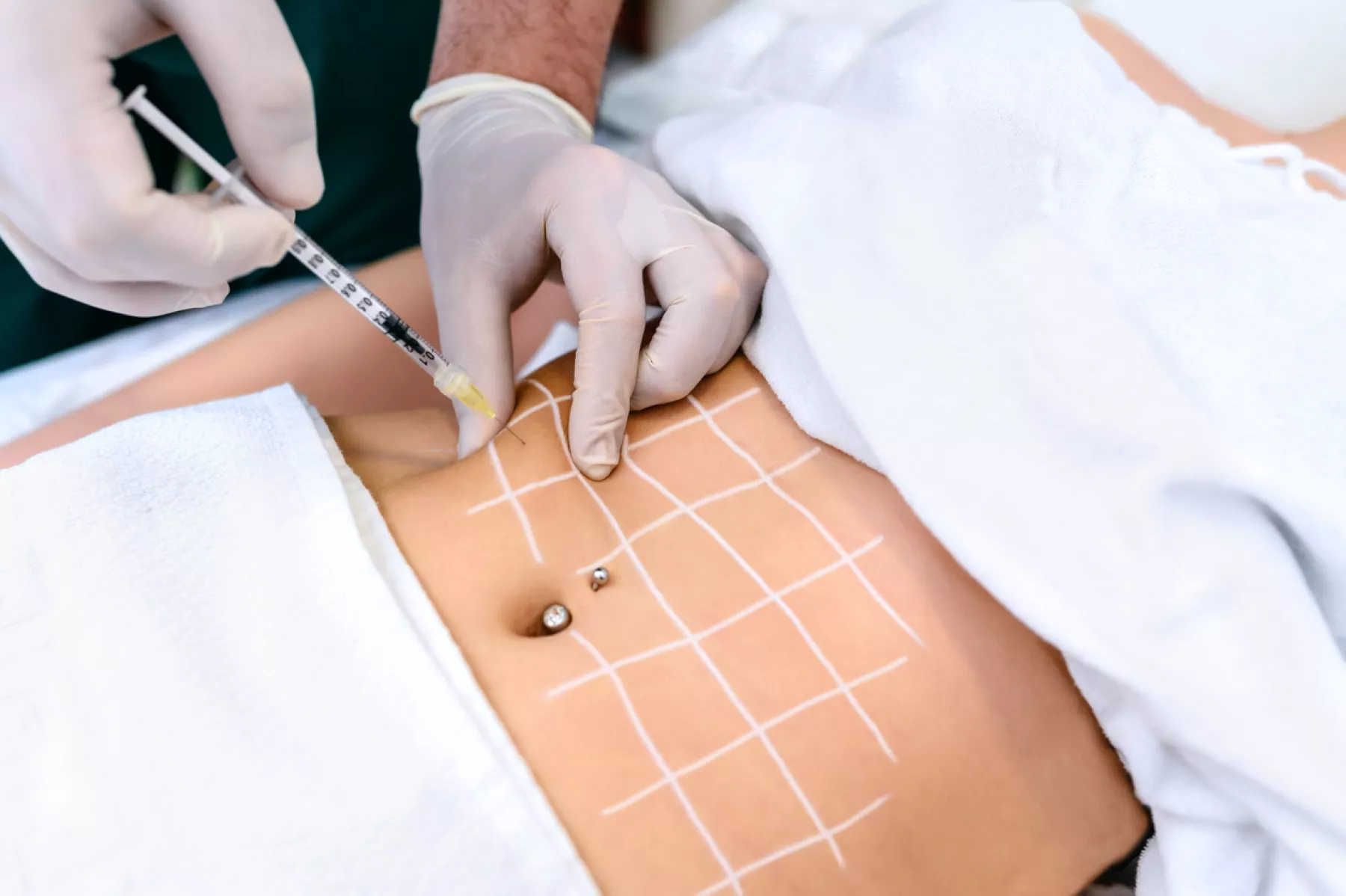 El médico cosmetólogo hace inyecciones de botox y rejuvenecimiento en el estómago de una mujer. Alisado de arrugas y arrugas en el abdomen con la ayuda de inyecciones de rejuvenecimiento con ácido hialurónico