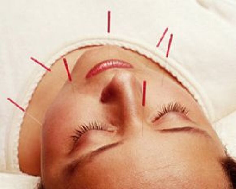 Básicamente tu acupunturista te citará como mínimo una vez por semana para la sesión, en donde colocará agujas en puntos específicos de tu cuerpo.