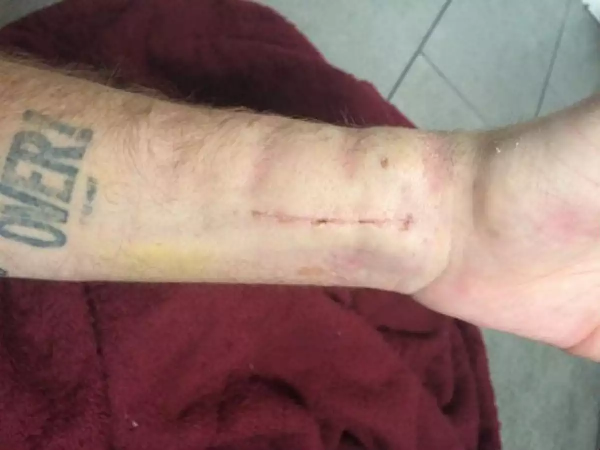 Drake Bell tuvo que entrar a cirugía tras romperse el brazo.