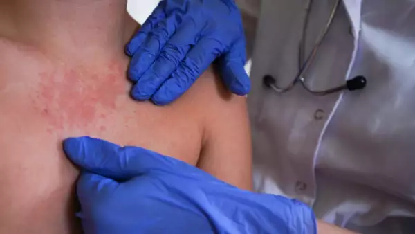 Ceguera, fallo renal y la muerte: Las complicaciones que provoca el sarampión