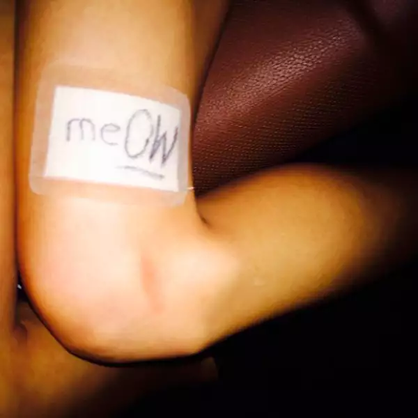 Después de la herida se puso un parche para su pronta recuperación.