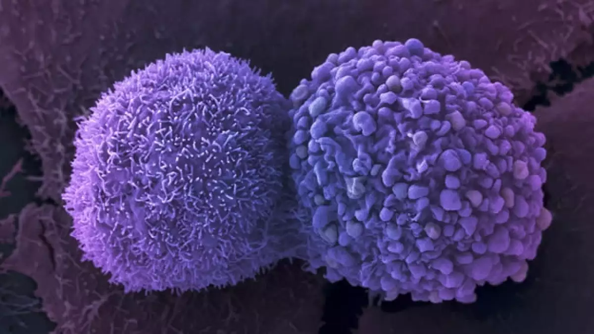 celulas de cancer de pulmon