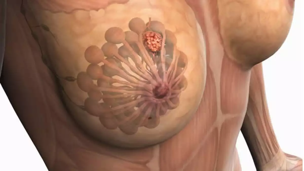 cancer mama