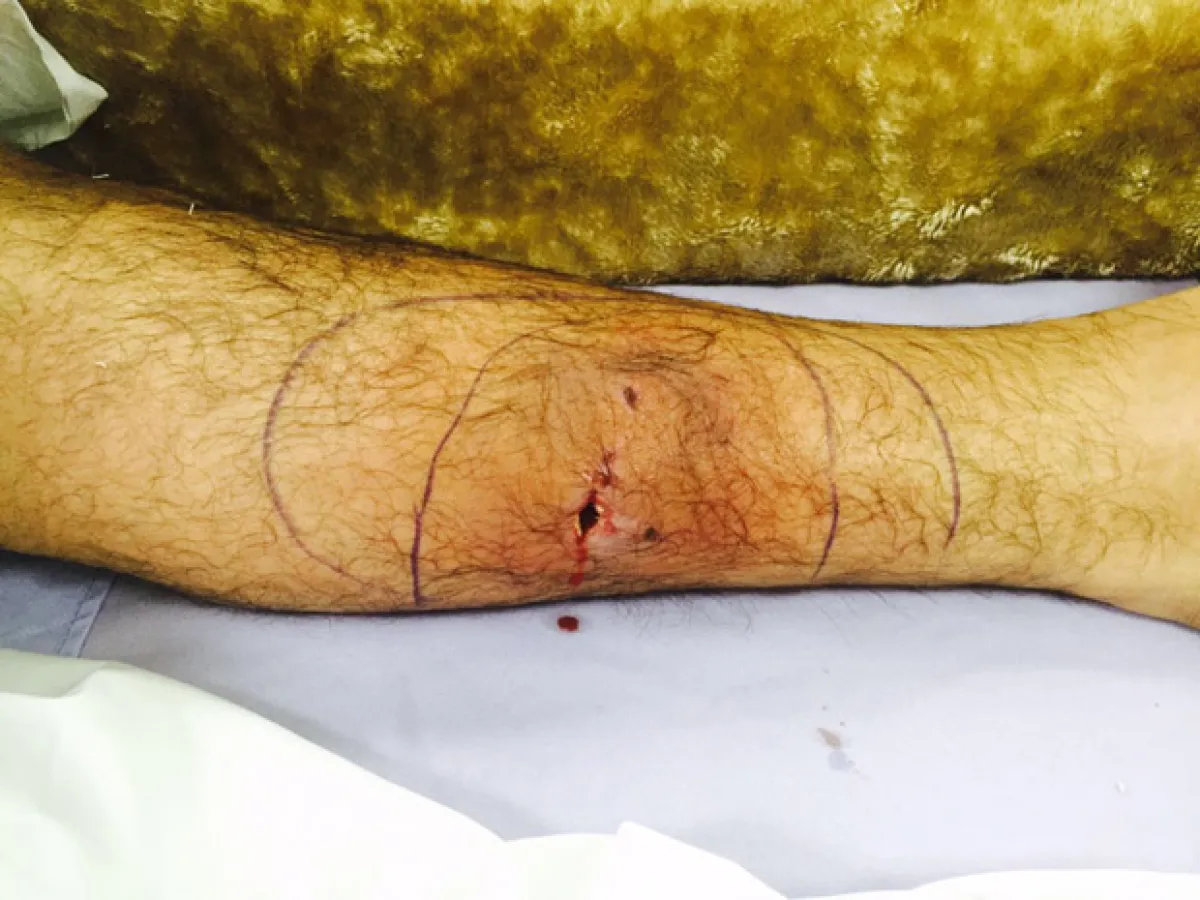 Esta fue la herida que le hizo su perro en la pantorrilla.