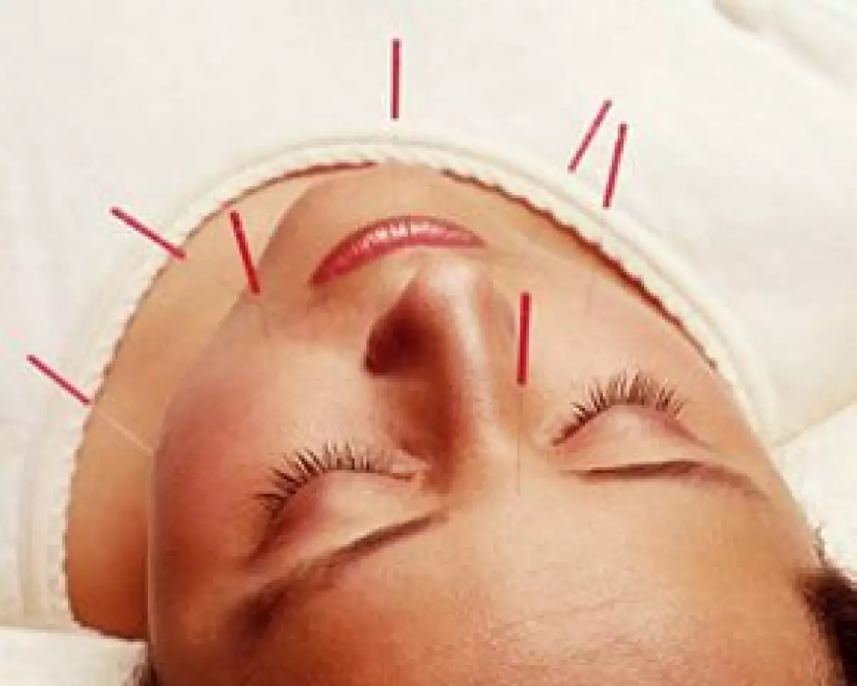 Básicamente tu acupunturista te citará como mínimo una vez por semana para la sesión, en donde colocará agujas en puntos específicos de tu cuerpo.