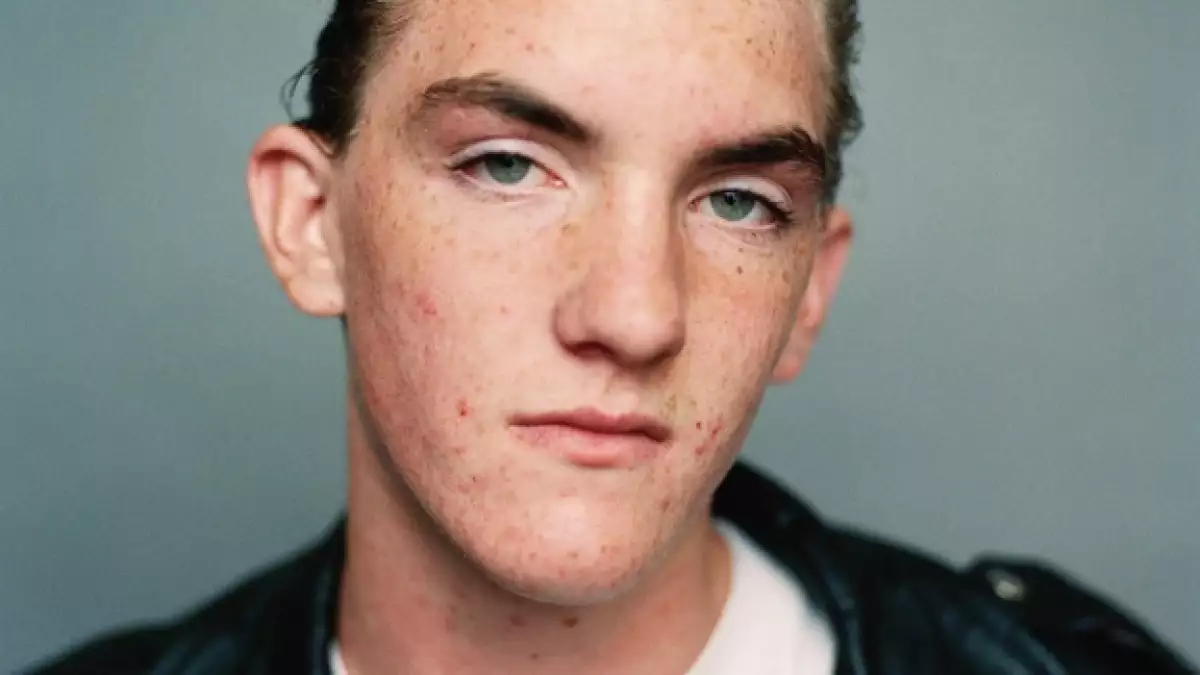 foto acne