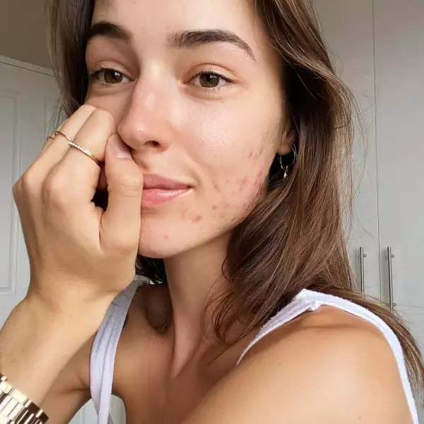 acne-positivity.jpg