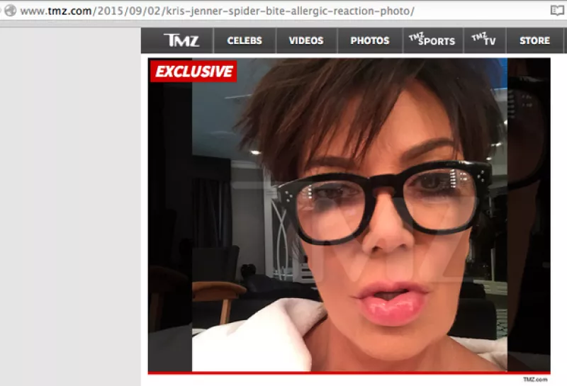 Aunque se dijo que Kris había fingido sufrir una picadura para evitar ir a un programa de televisión, TMZ consiguió una imagen de cómo quedaron sus labios.