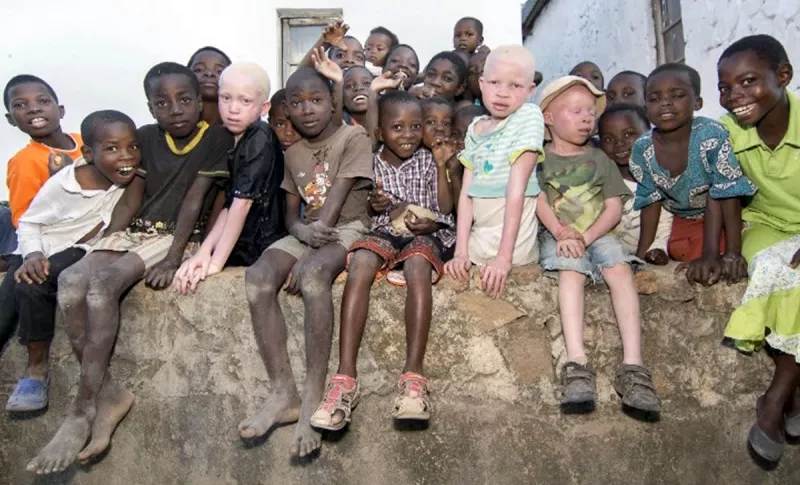 Los niños albinos son asesinados para vender sus huesos.