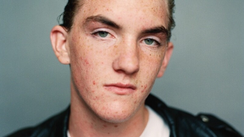 foto acne