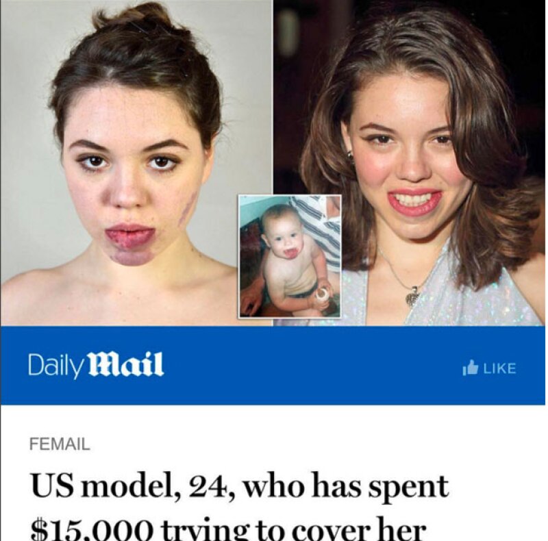 En entrevista con Daily Mail, Celina reveló que en sus 24 años de vida ha gastado 15 mil dólares entre tratamientos y operaciones en su cara.