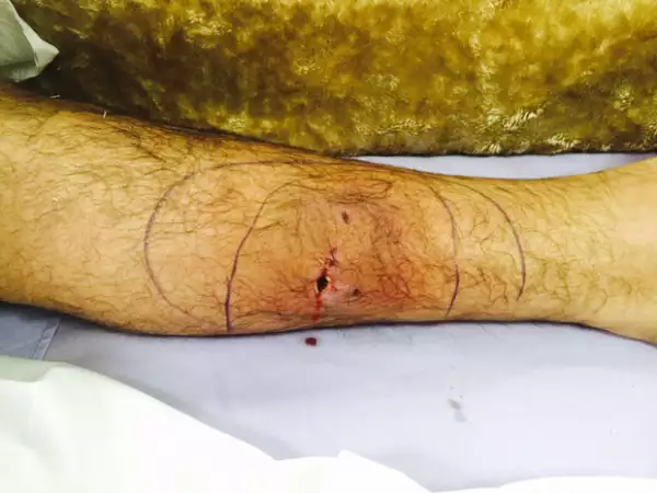 Esta fue la herida que le hizo su perro en la pantorrilla.