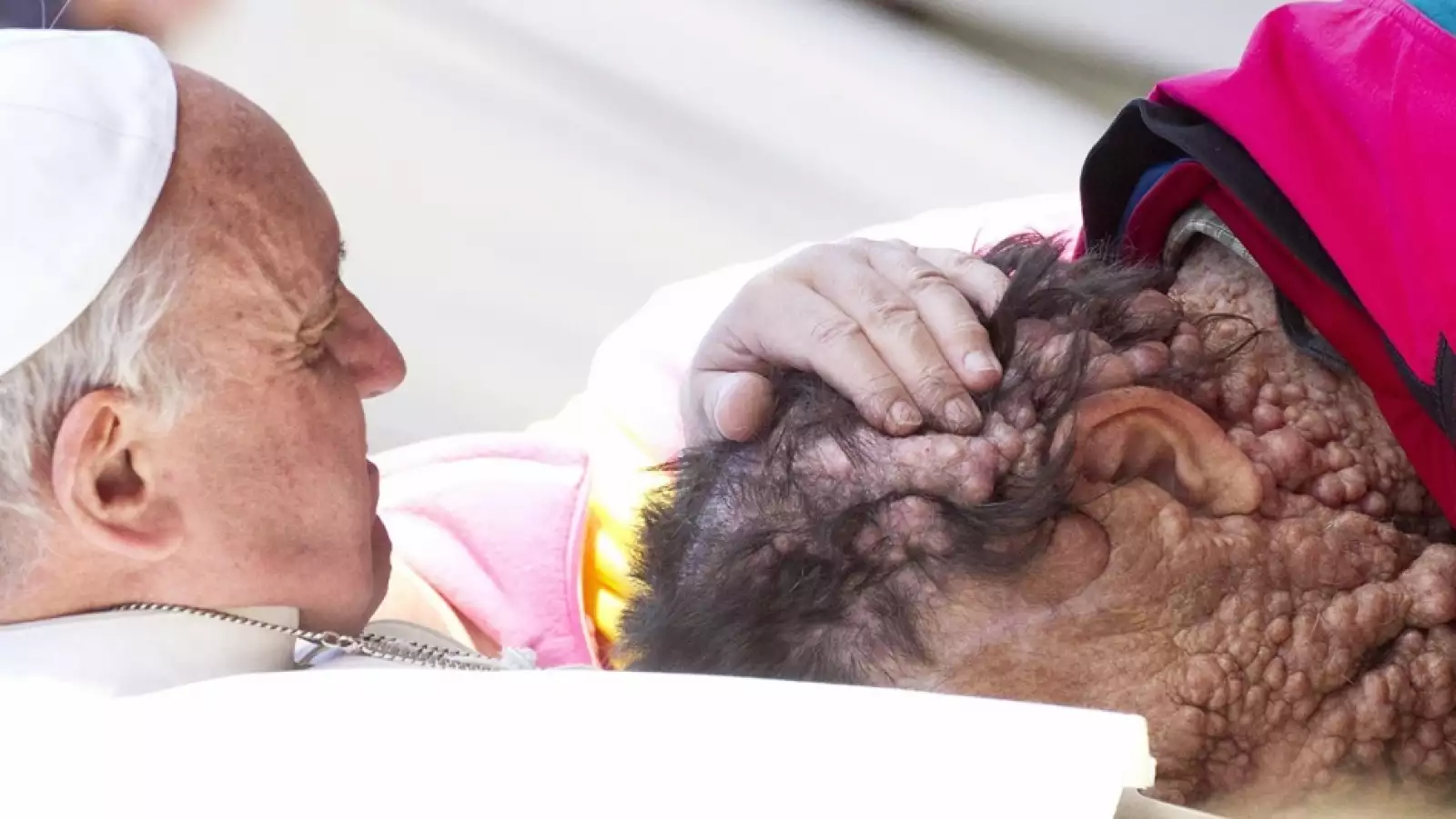 papa_enfermo_neurofibromatosis