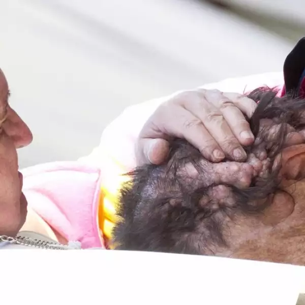 papa_enfermo_neurofibromatosis