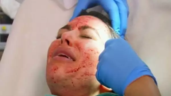 La estrella de reality show no sólo mostró ante millones de espectadores en televisión su facial llamado `vampiro´, también subió fotos a su cuenta de Instagram.
