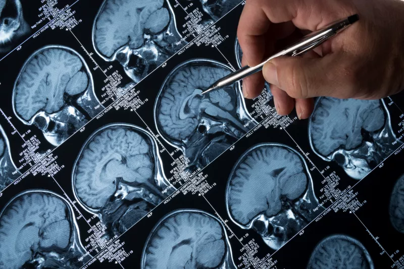 enfermedades-neurologicas
