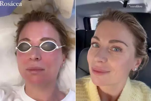Ludwika Paleta: Antes y después del tratamiento con láser para la rosácea