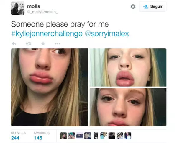 Moretones y labios inflamados, es lo que causa este reto.